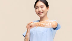 Person with Vitiligo