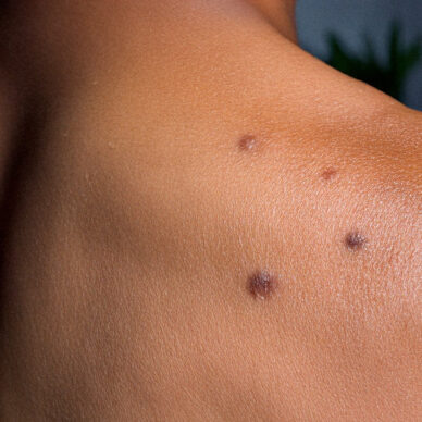 Skin lesions on persons shoulder